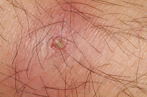 Pus: What is it and why does it happen? Lancing A Boil, Boils On Buttocks, Boil Popping Videos, Tattoo Healing Stages, Castor Oil Benefits Skin, Skin Boil, Squeezing Blackheads, Tattoo Peeling, Synovial Fluid