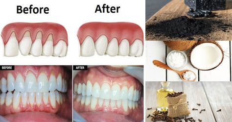 Do you suffer from receding gums? And if you do, did you know that there are many natural remedies that help grow back your receding gums in just a few weeks? Receding gums are basically just that – gums that have receded. It occurs when the gum tissues around your teeth wear away, and the Grow Back Receding Gums, Sensitive Teeth Remedy, Remedies For Tooth Ache, Swollen Gum, Healthy Gums, Gum Recession, Loose Tooth, Teeth Health, Gum Health