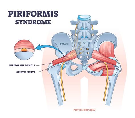 Piriformis Syndrome Piriformis Syndrome Exercises, Sciatic Nerve Pain Relief, Tension Release, Hip Mobility Exercises, Piriformis Muscle, Hip Pain Relief, Piriformis Syndrome, Health Words, Sciatica Pain Relief