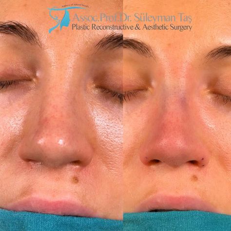 Revision rhinoplasty before and after 3 Hyloranic Acid, Nasal Tip Rhinoplasty, Rhinoplasty Turkey, Rhinoplasty Swelling Progression, Revision Rhinoplasty, Rhinoplasty Before After Dorsal Hump, Rhinoplasty Before And After, After 3, The Nose