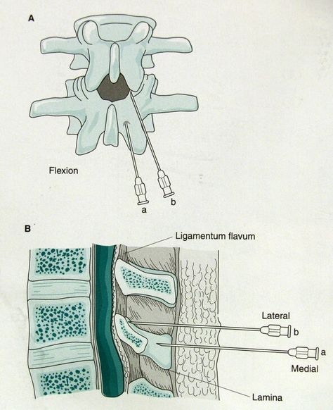 How to do epidural or spinal anesthesia Spinal Anesthesia, Anesthesia School, Crna School, Nurse Anesthesia, Human Anatomy Art, Drawings Simple, Anatomy Art, Human Anatomy, Women's Health