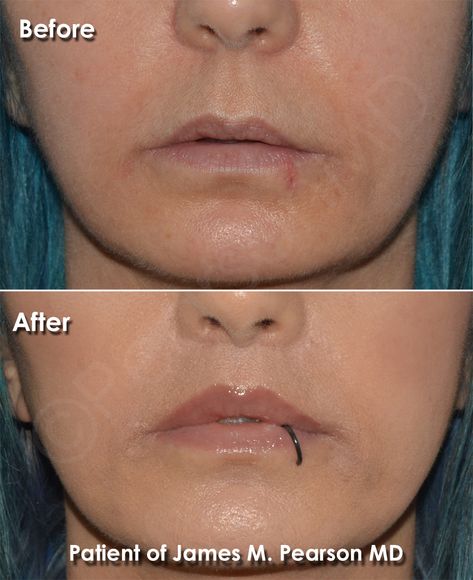 Photo Lip Lift by Dr. James Pearson Facial Plastic Surgery Lip Lift, Facial Bones, Lip Enhancement, Facial Plastic, Reconstructive Surgery, Lip Shapes, Alternative Treatments, Upper Lip, Return To Work