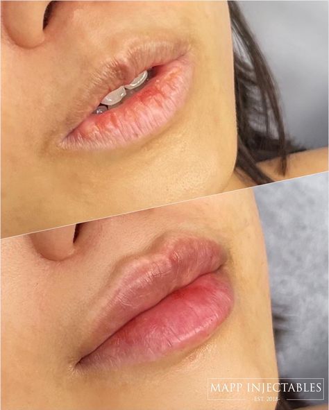 Lip Filler, Lip Fillers, Soft Lips, Your Lips, Website Link, Makeup Art, Curly Hair, To Look, Link In Bio