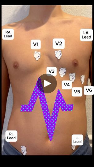 26 reactions | 12 Lead EKG placement ##nursing#nursingschool #nursingstudent #nurse #nursinglife #nursingstudents #nursingnotes #nursingnote #nclex#nclexprep #nursingexams #nursingeducation #nursinglife #nursingbundle #nursingclinical #smallnursingbusiness #nursingbundlenotes #futurenurses #bsn #nursingtiktok #nursesofinstagram #ekg #12lead #nursingeducation #nursingschooltips #CapCut | Professormollie 12 Lead Ekg Interpretation Cheat Sheets, Nclex Maternity Cheat Sheet, Ekg Placement, 12 Lead Ekg Placement Nursing Students, 12 Lead Ekg Placement, 5 Lead Ekg Placement, Ecg Lead Placement, Nursing School Tips, Nursing Education