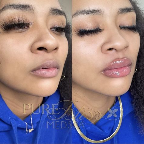 Heavy Upper Lip Filler, Needle Less Lip Filler, Babydoll Lip Filler, Lip Filler Before And After Black Women, Lip Filler Black Women, Needless Lip Filler, Lip Injections Before And After, Dream Lips, Facial Balancing