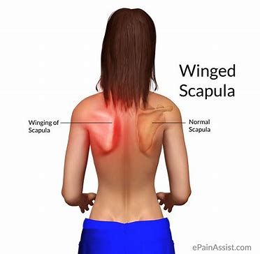 Winged Scapula Exercises, Scapular Winging, Scapula Exercises, Winged Scapula, Posture Fix, Tight Hip Flexors, Posture Exercises, Psoas Muscle, Shoulder Injuries