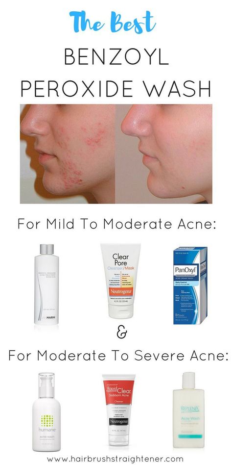 I've been treating my stubborn acne with Benzoyl Peroxide washes for years- because they work fast! Check out which ones are the best for mild or severe acne right here! #acneproducts Benzoyl Peroxide Wash, Skin Care Procedures, Moderate Acne, Stubborn Acne, Skin Care Routine For 20s, Severe Acne, Acne Cleansers, Acne Problem, Benzoyl Peroxide