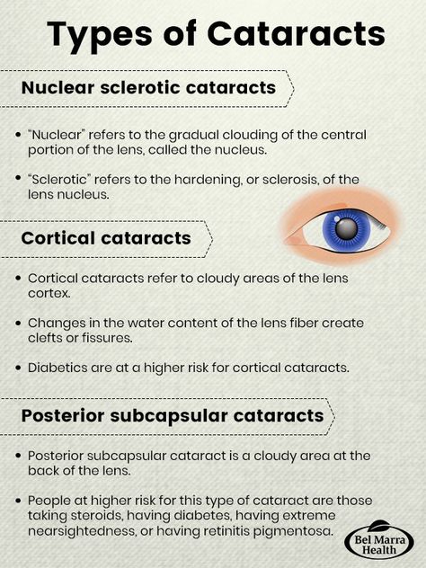 Types of #cataracts Opthalmic Technician, Ophthalmic Technician, Optician Training, Eye Health Facts, Optometry Education, Dry Eyes Causes, Eye Facts, Eye Anatomy, Visual Impairment