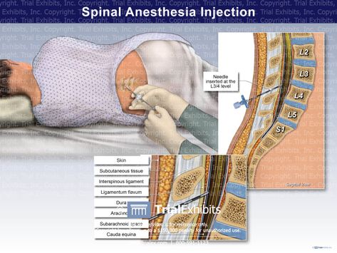 Spinal Anesthesia, Anesthesia School, Doctor Girl, Medical Drawings, Spinal Column, Jury Trial, Medical Student Study, Sciatic Nerve Pain, Birth Labor