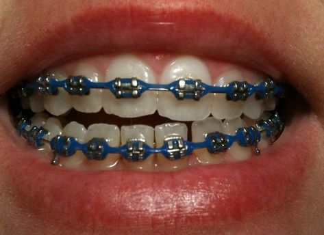 Dark Blue Braces, Power Chain Braces, Dental Braces Colors, Braces Colors Combinations, Braces Colors Ideas, Kawat Gigi, Straighten Teeth, Braces Bands, Cute Braces Colors