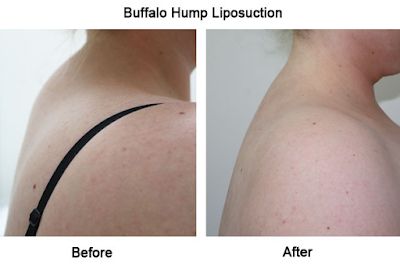 How To Get Rid Of A Buffalo Hump Neck Fat Exercises, Back Hump, Shoulder Range Of Motion, Dowager's Hump, Upper Back Exercises, Neck Hump, Forward Head Posture, Neck Exercises, Perfect Posture