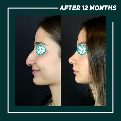 Dorsal Hump Rhinoplasty, Dorsal Hump Nose, Petite Nose, Makeup Scrapbook, Hump Nose, Visualization Board, Rhinoplasty Nose Jobs, Rhinoplasty Before And After, Facial Structure