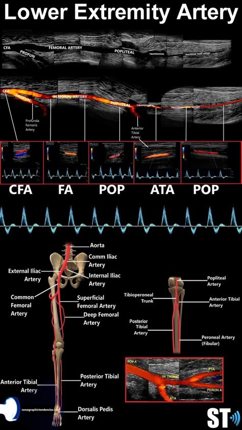 Vascular Ultrasound Anatomy, Lower Extremity Arterial Ultrasound, Lower Extremity Venous Ultrasound, Carotid Artery Ultrasound, Sonography Student Study, Ultrasound Anatomy, Diagnostic Medical Sonography Student, Ultrasound School, Arteries Anatomy