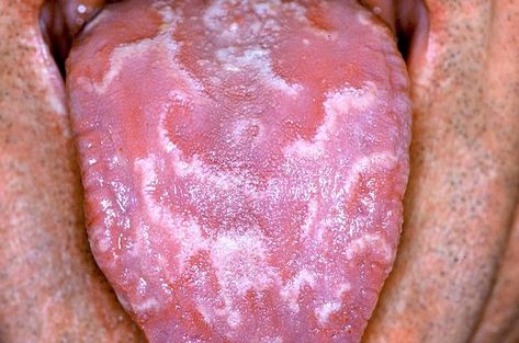 Tongue problems ? Check out our complete guide for easy to read information on how to diagnose and treat them Canker Sore Causes, Ulcer On Tongue, Tongue Problems, Healthy Tongue, Tongue Sores, Lichen Planus, Oral Pathology, Poor Nutrition, Canker Sore