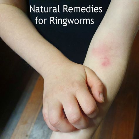 People and furbabies can be affected by ring worms. What is ringworm? Ringworm is a fungal infection of the skin. It’s not related to an actual worm, but instead gets its name from the circular rash that forms on the skin of people who’ve been infected. Ringworm is also known… Ring Worm Remedies, Skin Repair Cream, Fungal Infection Skin, Kids Skin Care, Essential Oil Remedy, Oil Remedies, Homemade Cleaning Solutions, Homemade Cleaning, Dry Skin Patches