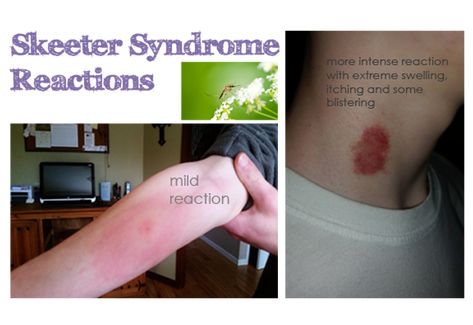 Skeeter Syndrome, Anaphylactic Shock, Bug Off, Honey Shop, Hit The Floor, Mosquito Bite, Infused Oils, Mayo Clinic, Essential Oil Bottles