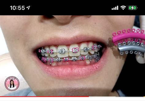 August Braces Colors, Pink And Blue Braces, Braces Patterns, Star Braces, Brackets Aesthetic, Dental Braces Colors, Pink Braces, After Braces, Cute Braces Colors