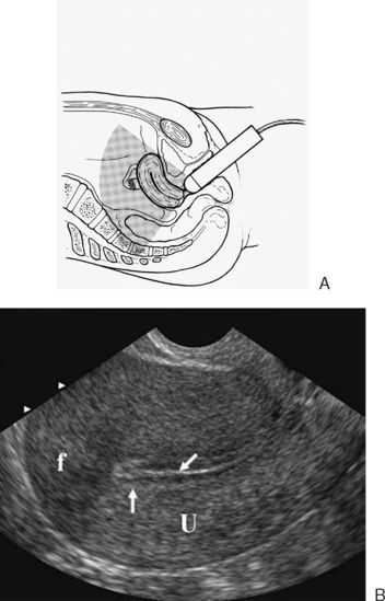 It Uterus Ultrasound, Vascular Anatomy, Pelvic Anatomy, Female Pelvis, Urinary Bladder, Rectus Abdominis Muscle, Transversus Abdominis, Psoas Muscle, Fallopian Tubes