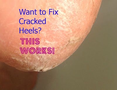 Callous Remover Diy, Listerine Foot Soak Recipe, Cracked Heels Diy, Heal Cracked Heels, Feet Remedies, Cracked Heel Remedies, Callous Remover, Listerine Foot Soak, Listerine Mouthwash