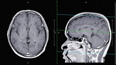 Pituitary Gland Tumor, Pituitary Tumor, Anterior Pituitary, Blood Pressure Chart, Pituitary Gland, Genetic Mutation, Medical News, Growth Hormone, Aids Hiv