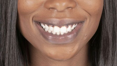 Black Gums: Causes and Symptoms Smile White Teeth, V34 Colour Corrector, Dark Gums, Colour Corrector, Whitening Teeth, Perfect Teeth, White Smile, Black Patch, Black Person