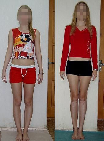 Simultaneous leg lengthening for height increase and bow legs correction. 1 - before the surgery, 2 - after 7 cms legs lengthening and bowlegs correction by Ilizarov apparatuses Knock Knees Correction, Genu Varum, One Legged Squat, Bow Legged Correction, Knock Knees, Weight Bearing Exercises, Correct Posture, Leg Bones, Bow Legged