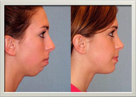 Cosmetic Surgery: What is cheek augmentation, its benefits and recovery? Jaw Reduction Surgery, Rhinoplasty Recovery, Cheek Implants, Natural Person, Plastic Surgery Fail, Korean Plastic Surgery, Chin Augmentation, Chin Implant, Plastic Surgery Gone Wrong