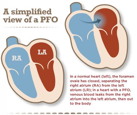 Hole In The Heart, Hole In Heart, Heart Valves, Normal Heart, Ultrasound Pictures, Heart Care, Fetal Development, American Heart Association, Heart Problems