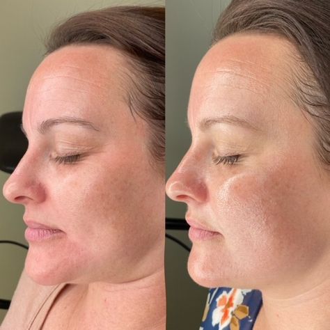 Wrinkles Before And After, Biorepeel Before And After, Retinol Results, Retinol Before And After, Chemical Peel Before And After, Chemical Peel Results, Facial Before And After, Vi Peel, Botox Facial