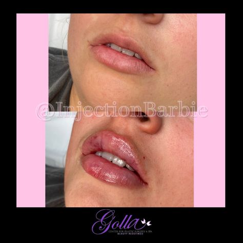 Lip Flip Aesthetic, Before And After Lip Flip, Lipfiller Before After, Lip Flip And Filler, Lip Flip Before And After, Lip Flip Botox Before And After, Beauty Surgery, 2023 Affirmations, Mini Face Lift