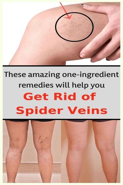 MY GRANDMOTHER TAUGHT ME THIS REMEDY TO ELIMINATE VARICOSE OR SPIDER VEINS. NOW MY LEGS LOOK AMAZING! Spider Vein Remedies, Spider Vein Removal, Get Rid Of Spiders, Varicose Vein Remedy, Vein Removal, Natural Healing Remedies, Natural Therapy, Natural Home Remedies, Natural Treatments