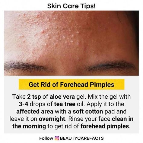 Forehead Pimples, Pimple Solution, Pimples On Forehead, Forehead Acne, Dry Skin Care Routine, Pimples Remedies, Clear Healthy Skin, Natural Face Skin Care, Natural Acne Remedies