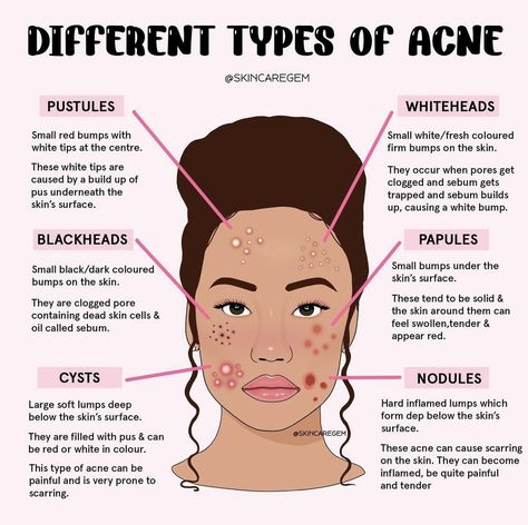 Different Types Of Acne, Face Mapping Acne, Skin Facts, Skin Advice, Skin Aesthetics, Clear Healthy Skin, Esthetician Room, Types Of Acne, Basic Skin Care Routine