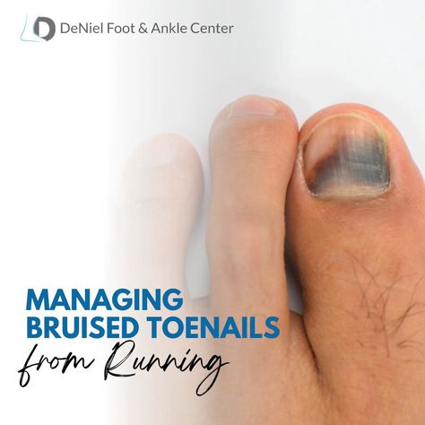 Running is an excellent form of exercise that promotes cardiovascular health, endurance, and overall well-being. However, it's not uncommon for runners to experience various foot-related issues, one of which is bruised toenails. Bruised toenails can be painful and bothersome, affecting your running performance and comfort. ⁠ #footdoctor⁠ #footandankle⁠ #podiatry⁠ #podiatrylife⁠ #podiatrist⁠ #houstondoctors⁠ #houstonfootdoctor #texasfootdoctor⁠ #houstonpodiatrist #texaspodiatrist⁠ Broken Toenail, Gel Toes, Long Distance Running, Keep Running, Cardiovascular Health, Listening To You, Toe Nails, Pain Relief, Well Being