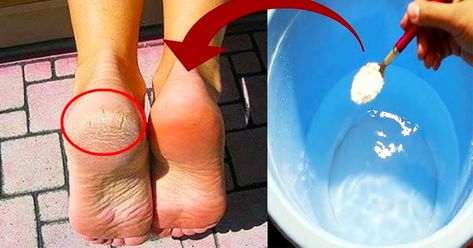 How To Get Rid Of Cracked Heels How To Soften Feet Heels, Dry Feet How To Get Rid Of, How To Heal Cracked Feet Fast, How To Get Rid Of Crusty Heels, How To Soften Feet At Home, Home Pedicure Soak Dry Heels, Healing Cracked Heels, Cracked Heel Remedy, Cracked Heels Diy