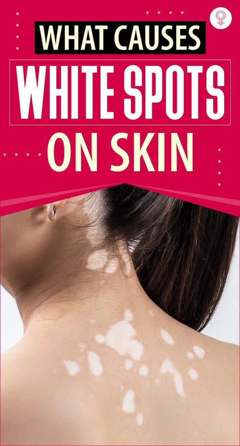 White Spots On Skin, White Skin Patches, White Skin Spots, Spots On Skin, Clogged Arteries, Tips Skincare, Skin Spots, Spots On Face, White Patches