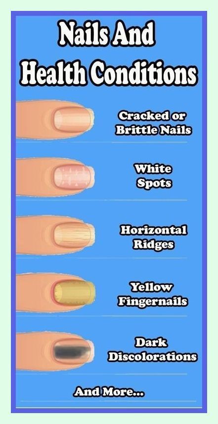 Nails And Health, Fingernail Health, Natural Antifungal, Nail Conditions, Nail Fungus Remedy, Health Signs, Tongue Health, Brittle Nails, Striped Nails