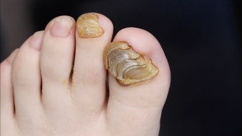 CRAZY TOENAIL SHELL?! SUPER THICK NAIL CLIPPING!!! #toebroclip Gross Toenails, Split Toenail, Curved Toenails, Ugly Toenails, Toenail Fungal Infection, Toenail Removal, Medical Videos, Toenail Polish, Ingrown Toe Nail