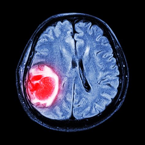 MRI combines with sound waves to reveal the stiffness of tumors Picture Of Body, Mri Brain, Genetic Mutation, Fat Loss Program, Body Tissues, Types Of Cancers, Radiology, Sound Waves, Blood Pressure