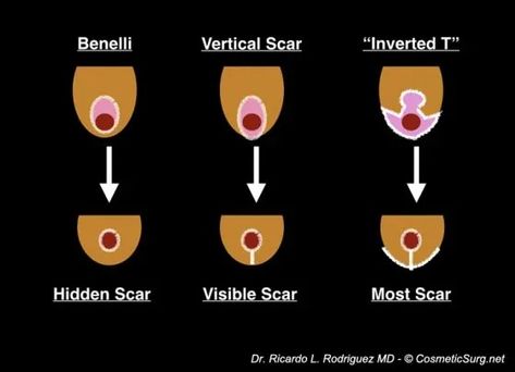 Breast lift scar options - Ricardo L. Rodriguez MD, Baltimore Face Procedures, Breast Lift Surgery, Laser Skin Resurfacing, Facial Fillers, Lip Augmentation, Neck Lift, Botox Injections, Skin Resurfacing, Breast Reduction