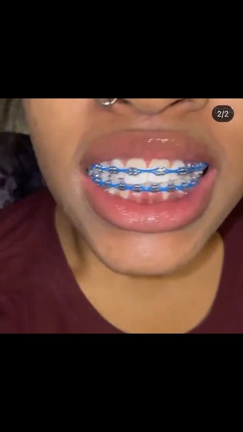 Braces Power Chain Aesthetic, Dark Blue Power Chain Braces, Braces Top Teeth Only, Royal Blue Power Chain Braces, Braces Aesthetic Power Chain, Braces Royal Blue, Bright Blue Braces, Braces Without Power Chain, Red Power Chain Braces