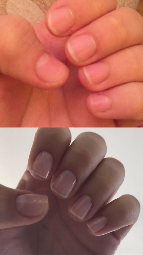 HiiIm new to this sub and i wanted to share my (smallnail growthI was wondering if using a mix of jojoba oilvitamin e oil and tea tree oil could possibly help with growing my nail bedsThanks for inspiring me to take care of my nailsnails nailsart Small Nail Bed Nails, Small Nail Beds, Short Nail Beds, Short Nail Bed, Nail Beds, Small Nail, Diy Nails At Home, How To Grow Nails, Nail Oil