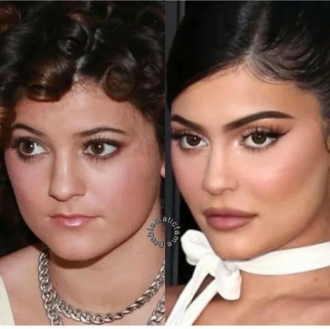 Kylie Before Surgery, Kylie Before And After, Kylie Jenner Face, Nose Surgery Rhinoplasty, Rhinoplasty Nose Jobs, Face Surgery, Plastic Surgery Gone Wrong, Facial Fillers, Facial Contouring