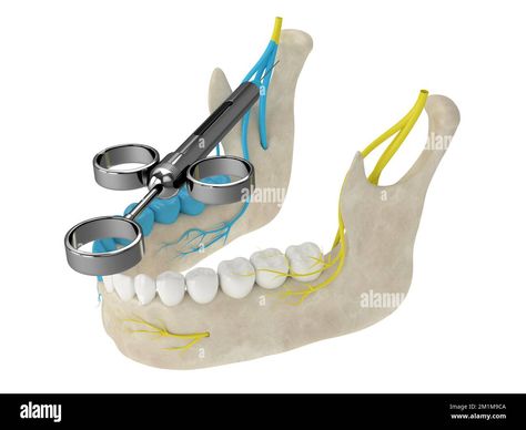 Download this stock image: 3d render of mandibular arch with gow-gates nerve block. Types of dental anesthesia concept. - 2M1M9CA from Alamy's library of millions of high resolution stock photos, illustrations and vectors. Dental Anesthesia, Image 3d, 3d Render, Nerve, Arch, High Resolution, Stock Images, Resolution, Stock Photos