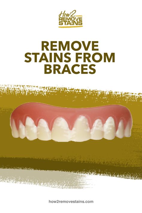 How to Remove Stains from Braces  [ Detailed Answer ]    Visit How2RemoveStains.com Braces Stains, Braces Removal, Teeth After Braces, Braces Rubber Bands, After Braces, Braces Bands, Teeth Stain Remover, Ceramic Braces, Getting Braces