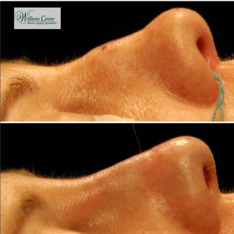 It's amazing how Dr. Williams can make small changes to the nose that make such a big impact on the way people feel about themselves. This real patient had an endonasal rhinoplasty to correct a mild saddle deformity. Rhinoplasty - Saddle Deformity: http://tinyurl.com/jybx4co #WilliamsCenter #DrEdwinWilliams #EndonasalRhinoplasty #nosejob #Rhinoplasty #NaturalResults #RhinoplastySpecialist Plastic Surgery Procedures, Albany Ny, Nose Job, The Nose, Small Changes, Plastic Surgery, Surgery, Saddle