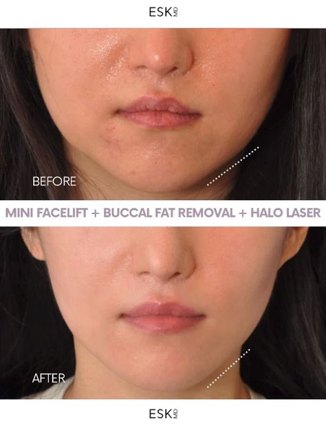 Look at the transformation power of a mini facelift in combination with buccal fat removal and halo laser!  #drkwak #dredwardskwak #eskmd #plasticsurgeon #nycplasticsurgeon #plasticsurgeons #plasticsurgery #plasticsurgerybeforeandafter #minifacelift #buccalfatremoval #halolaser Buckle Fat Removal, Kybella Before And After, Buccal Fat Removal, Halo Laser, Face Plastic Surgery, Mini Face Lift, Fuller Lips Naturally, Face Lift Surgery, Fuller Lips