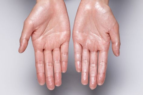 Sweaty Hands? Amazon’s Top-Ranked Antiperspirant Hand Lotion Can Help Sistem Saraf, Hand Sweating, Sweaty Palms, Sweaty Hands, Sweat Gland, Excessive Sweating, Homemade Face Masks, Homemade Face, Antiperspirant