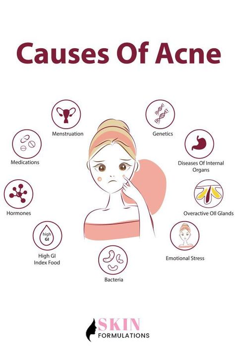 Causes Of Acne Cause Of Pimples, Causes Of Pimples, Cause Of Acne, Causes Of Acne, Pimple Causes, Acne Beauty, Blind Pimple, Skincare Advice, Pimples Under The Skin