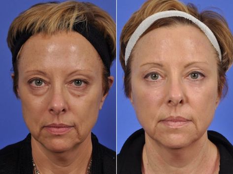 Laser Skin Resurfacing, Laser Resurfacing, Under Eye Puffiness, Skin Resurfacing, Laser Skin, Beauty Tips For Skin, Skin Toner, Cosmetic Procedures, Human Being